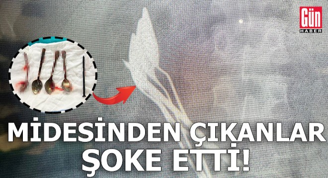 Çocuğun midesinden çıkanlar şoke etti!