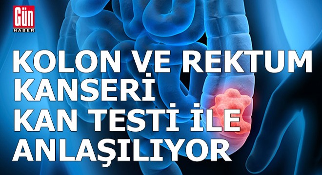 Gizli kan testi ile kolon ve rektum kanseri anlaşılabiliyor