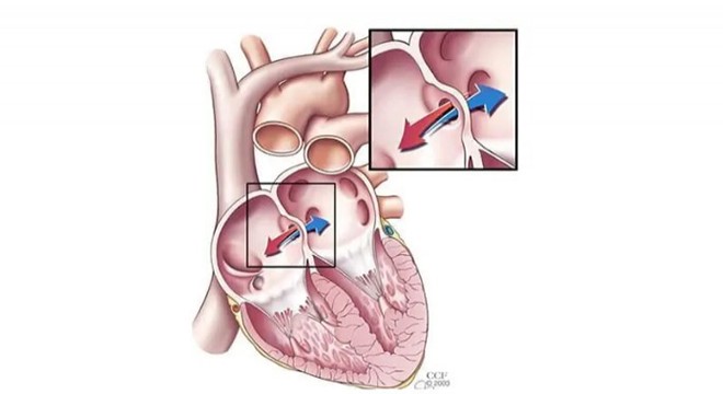 Kalp Sağlığında Yeni Bir Dönem ASD Kapama