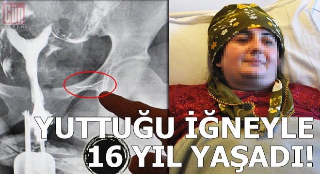 Yuttuğu dikiş iğnesiyle 16 yıl yaşadı